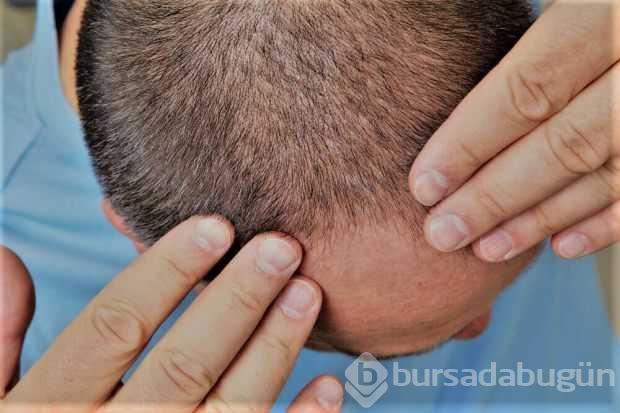 Saç dökülmesine iyi gelen besinler, Saç neden dökülür
