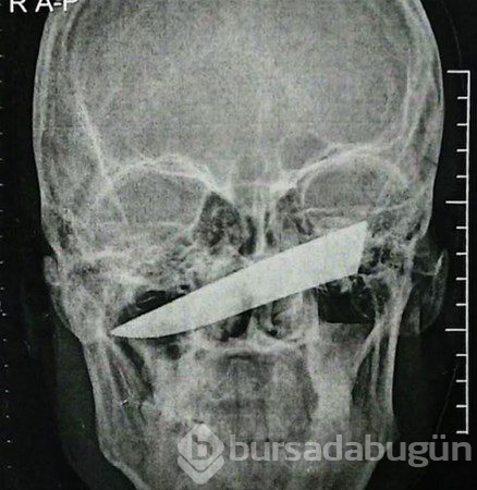 Şaşırtan röntgenler