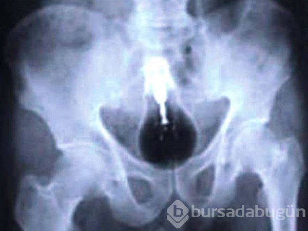 Şaşırtan röntgenler