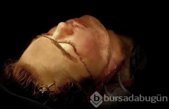 Yüzü parçalanan adamın inanılmaz değişimi!

