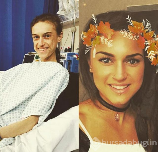 Emelle Lewis anoreksiya hastası olmuştu, son hali görenleri şaşırttı!
