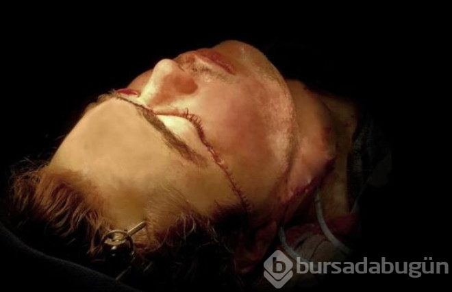 Kendini yüzünden vurup paramparça etmişti, yüz nakliyle hayata yeniden döndü
