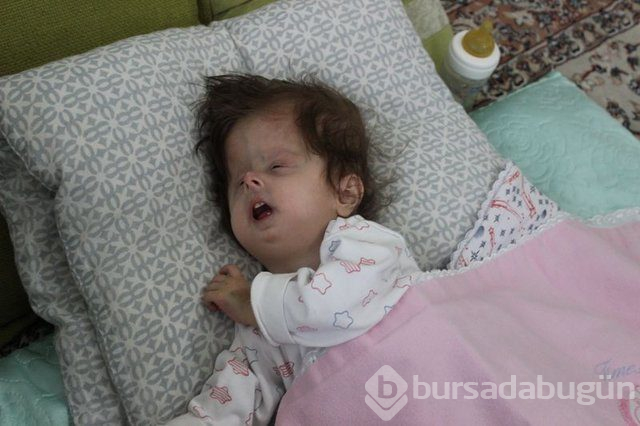 2 yaşındaki Hallerman-Streiff Sendromlu minik Hira yardım bekliyor!
