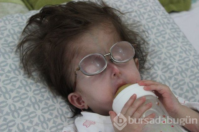 2 yaşındaki Hallerman-Streiff Sendromlu minik Hira yardım bekliyor!
