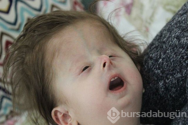 2 yaşındaki Hallerman-Streiff Sendromlu minik Hira yardım bekliyor!

