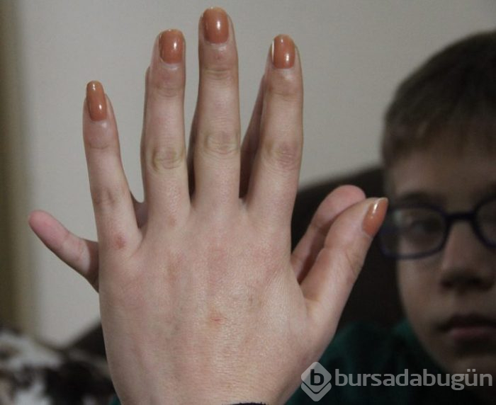 6 parmaklı Demirhan ne yazı yazabiliyor, ne ayakkabı bulabiliyor
