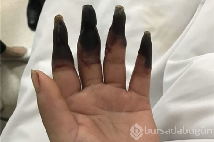 Aman dikkat! Ev işi yaptı iki gün sonra parmakları bu hale geldi
