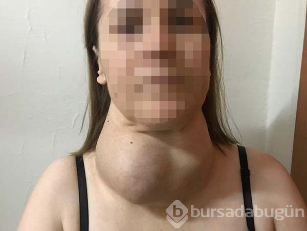 Ameliyattan korktu yıllarca böyle yaşadı
