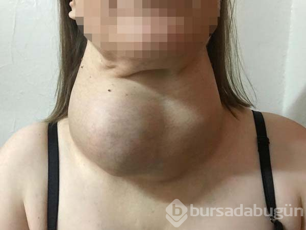 Ameliyattan korktu yıllarca böyle yaşadı
