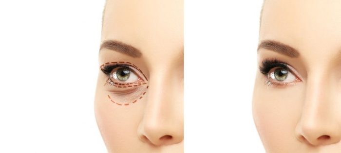 Yüz estetiğinde doğru bilinen 10 yanlış (Beklentileriniz ne kadar gerçekçi?)
