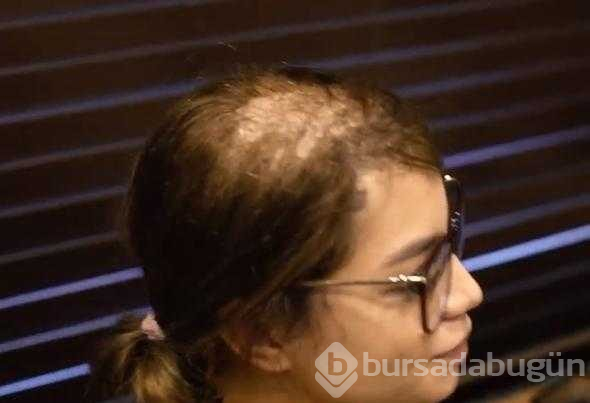 Dökülen saçları şaşırtmıştı! Meğer herkesi kandırmışlar
