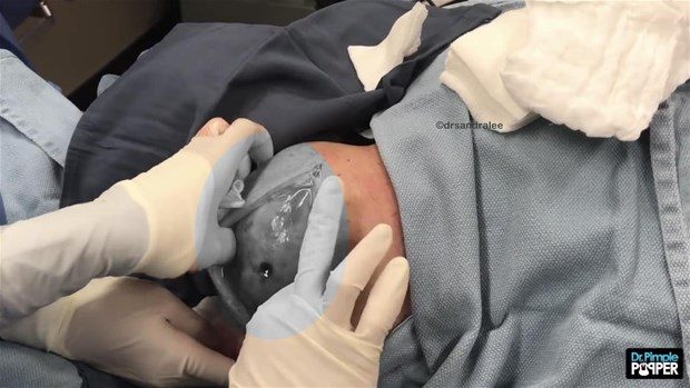 Boynunda kocaman kist vardı

