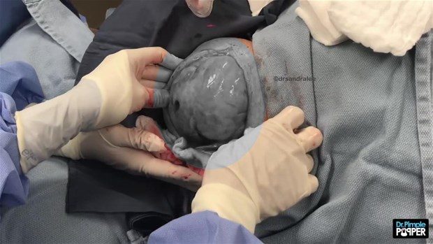 Boynunda kocaman kist vardı

