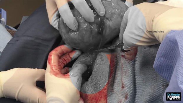 Boynunda kocaman kist vardı

