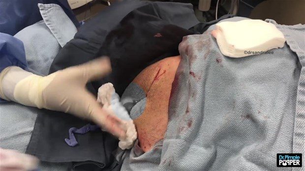 Boynunda kocaman kist vardı

