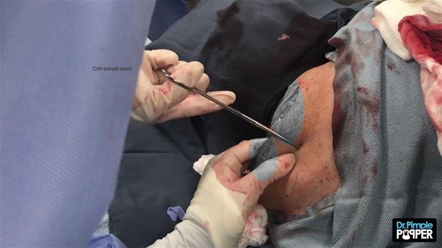 Boynunda kocaman kist vardı

