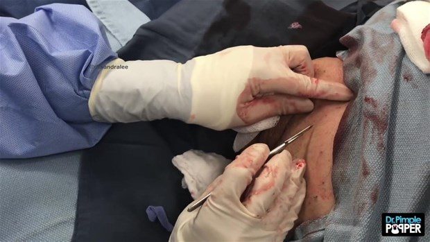 Boynunda kocaman kist vardı

