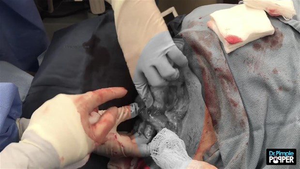 Boynunda kocaman kist vardı

