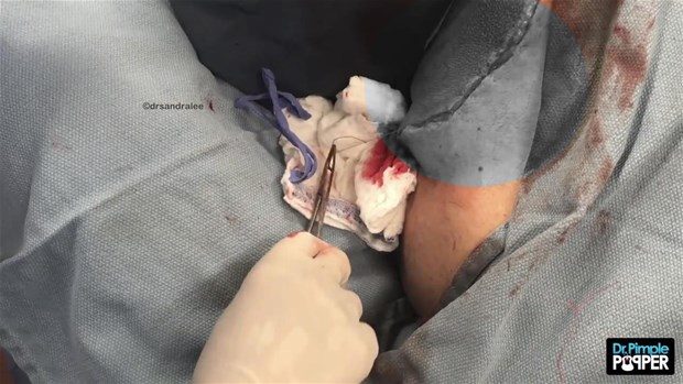 Boynunda kocaman kist vardı

