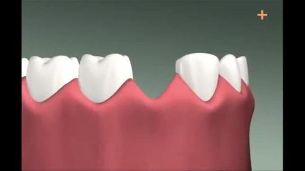 Diş implantı böyle yapılıyor

