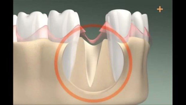 Diş implantı böyle yapılıyor

