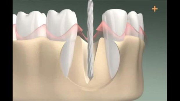 Diş implantı böyle yapılıyor


