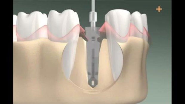Diş implantı böyle yapılıyor

