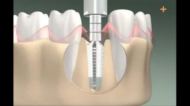 Diş implantı böyle yapılıyor

