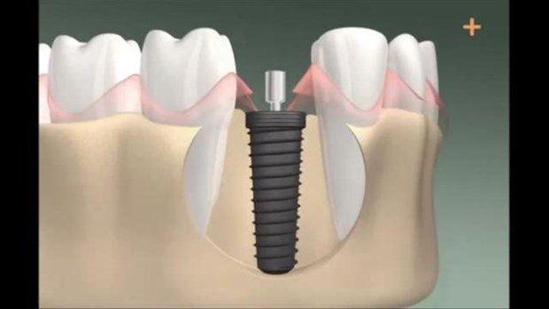 Diş implantı böyle yapılıyor

