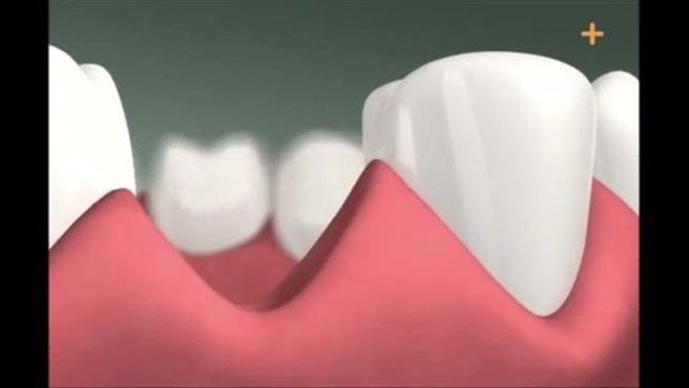 Diş implantı böyle yapılıyor

