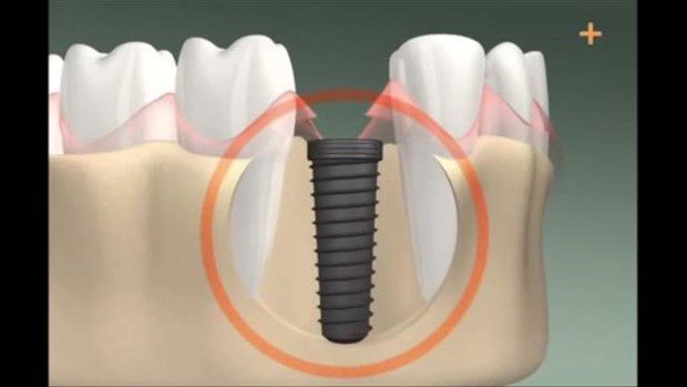 Diş implantı böyle yapılıyor

