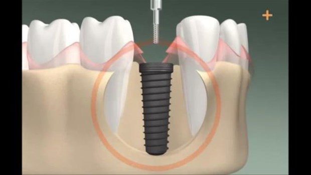 Diş implantı böyle yapılıyor

