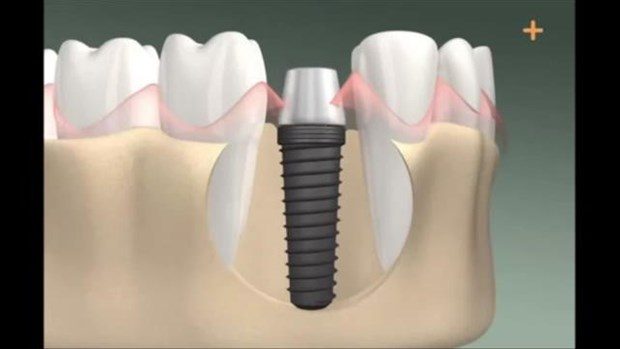 Diş implantı böyle yapılıyor

