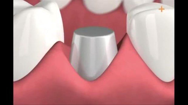Diş implantı böyle yapılıyor

