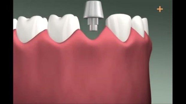 Diş implantı böyle yapılıyor

