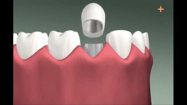 Diş implantı böyle yapılıyor

