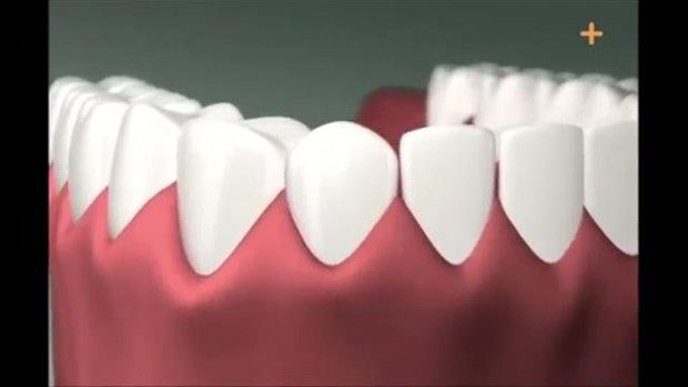 Diş implantı böyle yapılıyor

