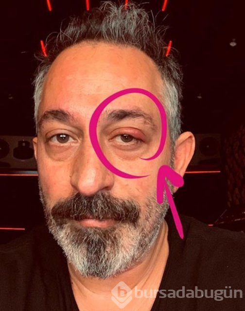 Cem Yılmaz'ın gözüne ne oldu?
