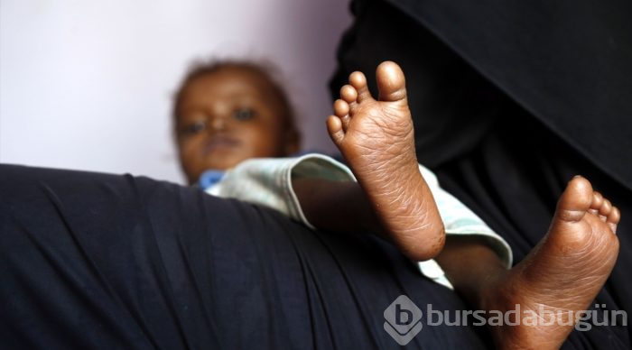 Yemen'de kıtlık en çok çocukları etkiliyor
