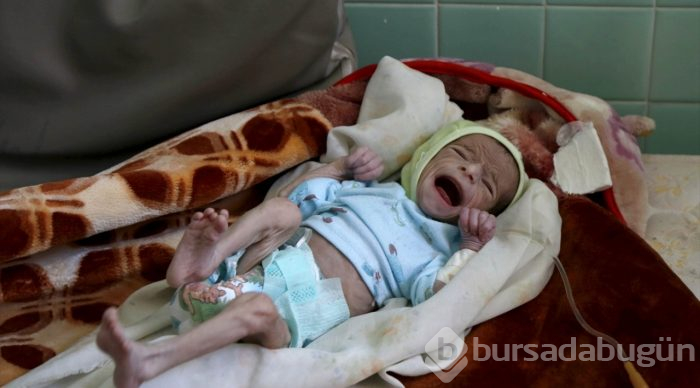 Yemen'de kıtlık en çok çocukları etkiliyor
