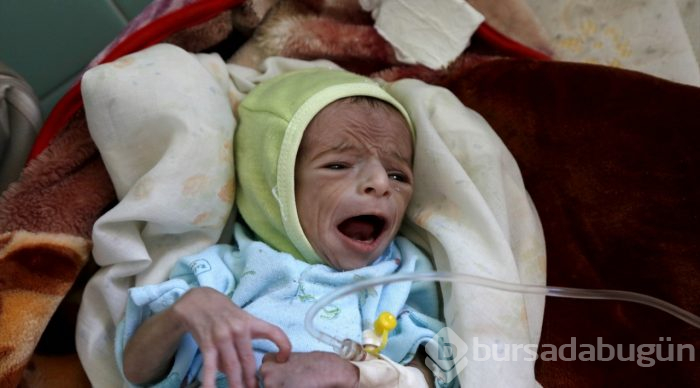 Yemen'de kıtlık en çok çocukları etkiliyor
