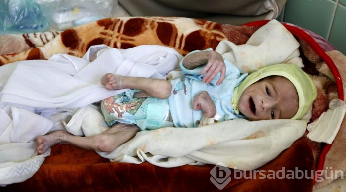 Yemen'de kıtlık en çok çocukları etkiliyor
