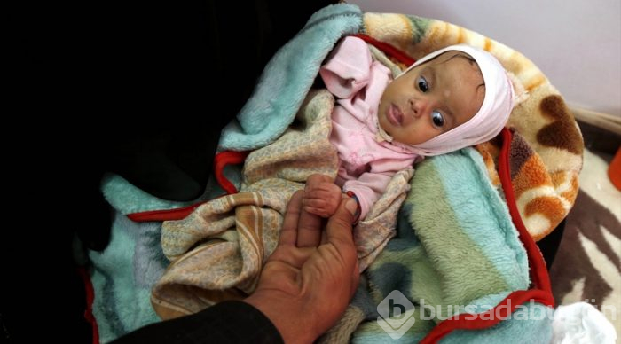 Yemen'de kıtlık en çok çocukları etkiliyor
