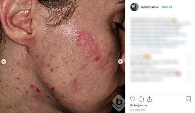 Restoranda elini yıkadı, bakteri kaptı
