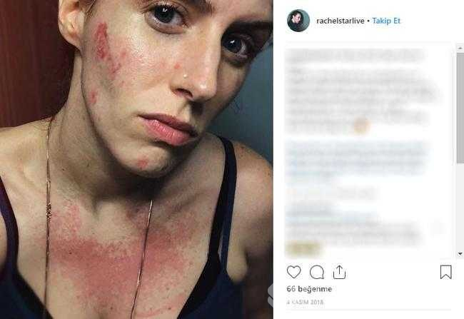 Restoranda elini yıkadı, bakteri kaptı

