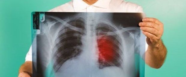 Göğüs ağrısının 5 önemli nedeni! (Her göğüs ağrısı kalp krizini düşündürmesin!)
