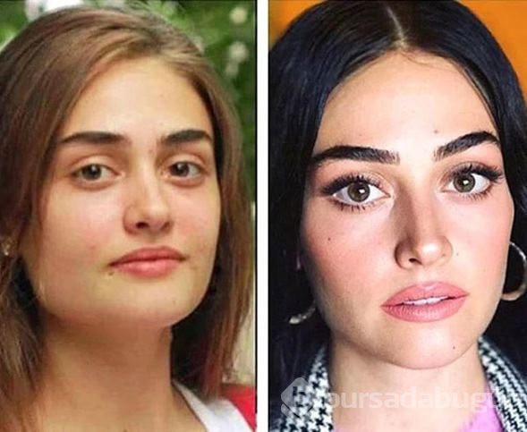 Esra Bilgiç'ten estetik açıklaması
