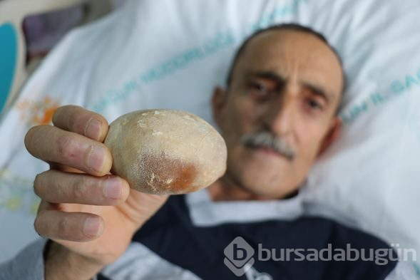 Doktorlar şoke oldu: Görünce patates sandım
