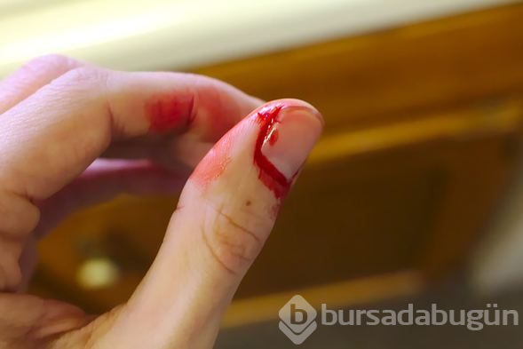  Hemofili hastalığıyla ilgili 7 önemli uyarı 