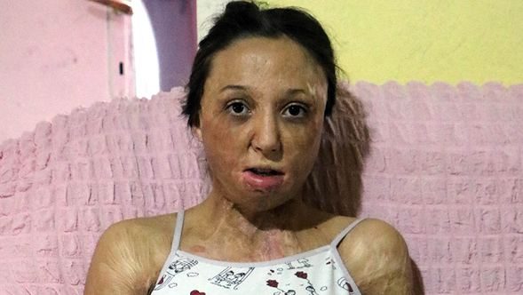  Zonguldak'ta vücudu ve yüzü yanan 13 yaşındaki yağmur yardım bekliyor 